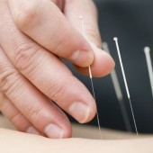 Akupunkturla Zayıflama